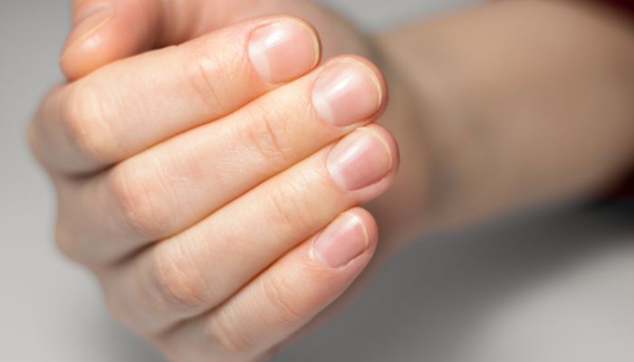 Fingernail Fungus: Discover 5 Tips to Get Rid of It Fast
